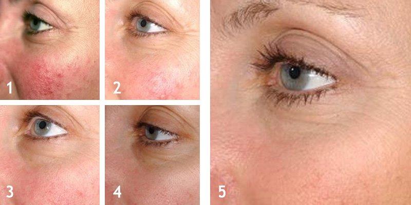 Rosacea (Vascular Lesions)
