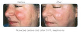 Rosacea (Vascular Lesions)